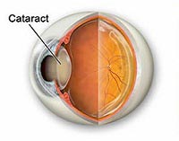 Cataract Treatment