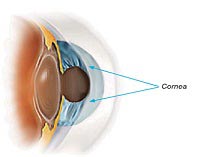 Cornea or Keratoconus Treatment